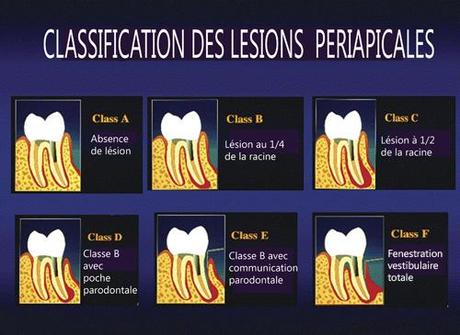Nouvelle classification des lésions endodontiques