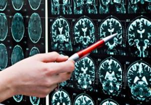 ÉPILEPSIE: Le premier dispositif qui prédit les crises – The Lancet Neurology