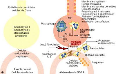 Chronologie de l’identification de lésions histologiques dans le syndrome de détresse respiratoire aiguë avec dommage alvéolaire diffus: étude prospective de cohorte d’autopsies cliniques