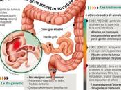 Mesure taux croissance volumétrique petits polypes colorectaux colographie TDM* étude longitudinale d’une histoire naturelle
