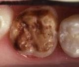 Bisphénol A : dangereux pour les dents