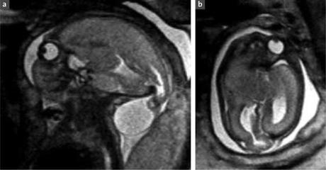 Défauts du tube neural: avancées récentes, questions non résolues, et controverses