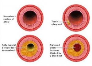 RISQUE CARDIAQUE: 2 gènes spécifiques liés à un risque accru de maladie coronarienne – Arteriosclerosis, Thrombosis, and Vascular Biology