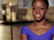 Michaela prince orpheline sierra leonaise souffrant vitiligo devient ballerine reconnue