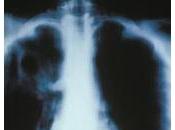VIANDE contaminée: tuberculose bovine panique Royaume-Uni NHS-DEFRA