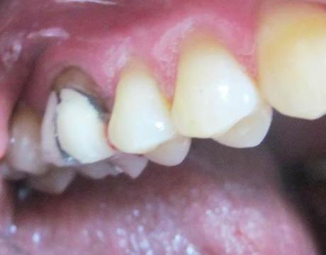 Récession gingivale postérieure : remplacement d'une CCM postérieure