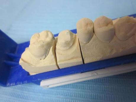 Récession gingivale postérieure : remplacement d'une CCM postérieure