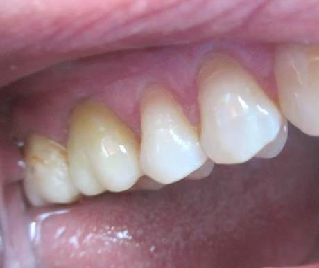 Récession gingivale postérieure : remplacement d'une CCM postérieure