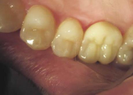 Récession gingivale postérieure : remplacement d'une CCM postérieure