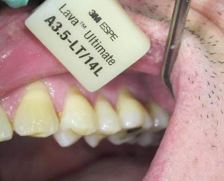 Récession gingivale postérieure : remplacement d'une CCM postérieure