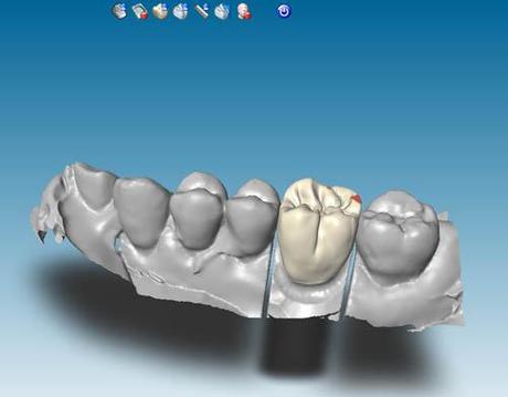 Récession gingivale postérieure : remplacement d'une CCM postérieure