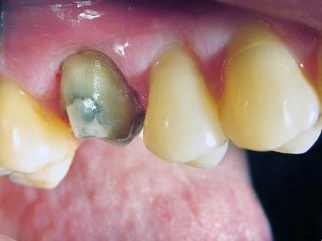 Récession gingivale postérieure : remplacement d'une CCM postérieure