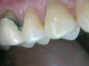 Récession gingivale postérieure remplacement d'une