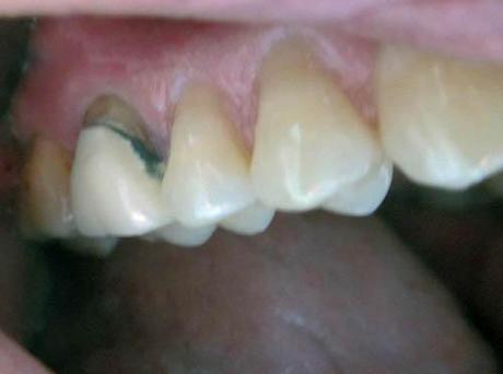 Récession gingivale postérieure : remplacement d'une CCM postérieure