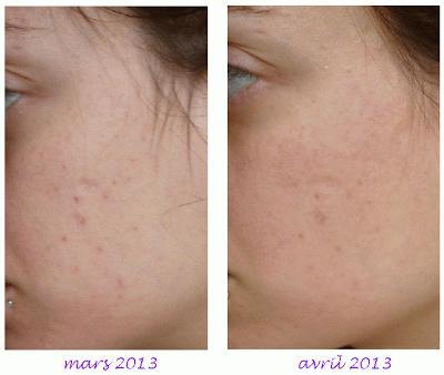 Le MSM ou souffre organique, efficace contre l'acné et les cicatrices d'acné !