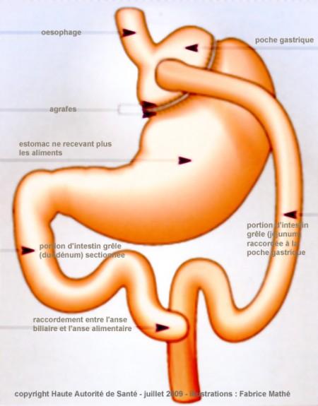 chirurgie-obesite-bypass-gastrique