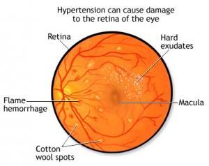 AVC: Votre risque rien que dans vos yeux  – Hypertension