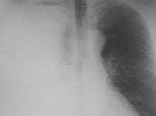 Administration tremelimumab patients atteints mésothéliome malin avancé resistant chimiothérapie: essai phase ouvert, groupe unique