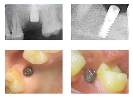 Cas clinique de couronne sur pilier implantaire CFAO (système Ti-Base de Sirona)