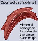 DRÉPANOCYTOSE : 4è journée d’information le 5 octobre 2013 – CHRU de Tours