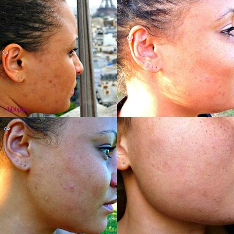Mon secret pour vaincre les taches d’acnés : le Mélano’régul