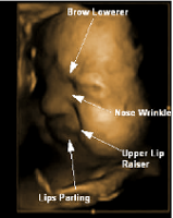 Les expressions faciales de douleur - détresse des foetus