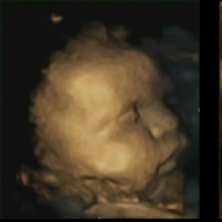 Les expressions faciales de douleur - détresse des foetus
