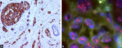Lapatinib comme élément d’une thérapie néoadjuvante pour le cancer du sein HER2-positif opérable (NSABP protocol B-41): une étude de phase 3 ouverte et randomisée