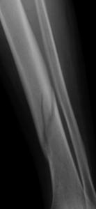 L'ALCOOL, ennemi de la cicatrisation de l'os en cas de fracture   – American Society for Bone and Mineral Research 2013