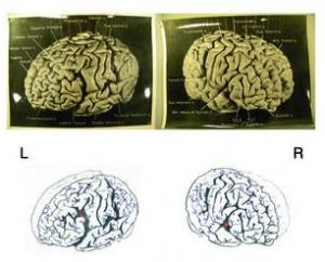NEURO: Le corps calleux d'Einstein explique son intelligence – Brain