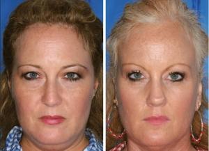 ESTHÉTIQUE: Les effets du tabac se lisent sur le visage – Plastic & Reconstructive Surgery