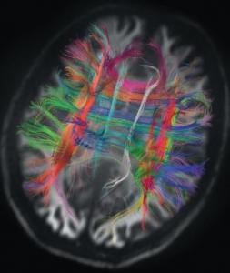 NEURO: Chaque neurone d'un même cerveau a son ADN perso – Science