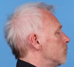 PELADE: Perte et blanchiment des cheveux, diagnostic et traitement – BMJ