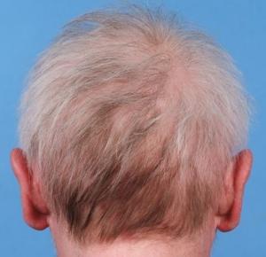 PELADE: Perte et blanchiment des cheveux, diagnostic et traitement – BMJ -  À Lire