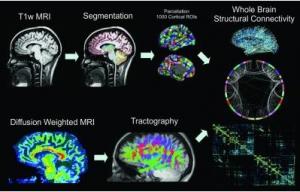 ÉPILEPSIE: Le cerveau privé de son mode par défaut – Radiology