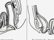Renforcement muscles pelviens chez femmes atteintes prolapsus pelvien (POPPY) essai multicentrique randomisé contrôlé