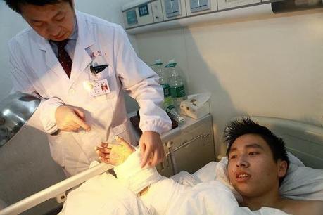 Un chinois se fait greffer sa main sur la cheville