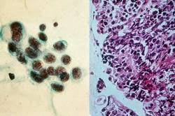 Docetaxel + nintedanib versus docetaxel + placebo chez des patients préalablement traités pour un cancer du poumon non à petites cellules (LUME-Lung 1) : essai de phase 3 en double-aveugle, randomisé et contrôlé