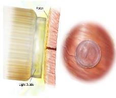 BIOINGÉNIERIE: De la superglue pour chirurgie cardiaque  – Science Translational Medicine