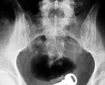 20 objets insolites se retrouvant coincés dans un rectum
