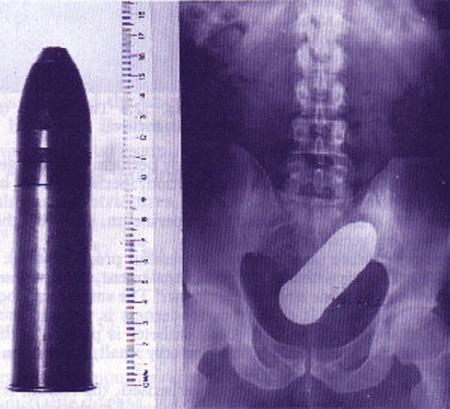 20 objets insolites se retrouvant coincés dans un rectum