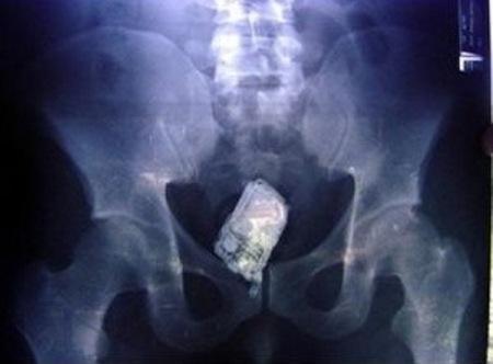 20 objets insolites se retrouvant coincés dans un rectum