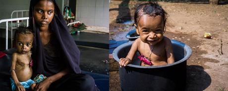 8 millions d’Indiens de moins de 5 ans souffrent de malnutrition aiguë sévère