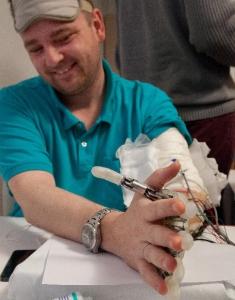 AMPUTATION: Première prothèse de main avec sens du toucher intégré – Science Translational Medicine