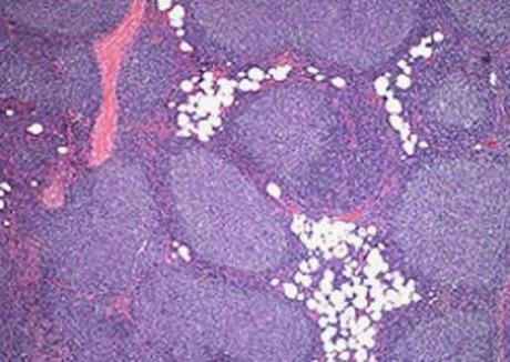 Pharmacocinétique et sécurité de l’administration de rituximab par voie sous-cutanée pour le lymphome folliculaire (SABRINA): analyse de la première étape d’un essai randomisé de phase 3