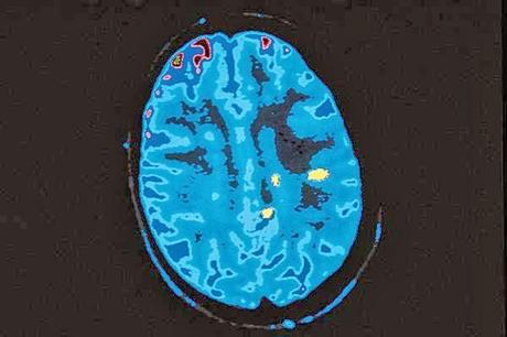 Atacicept et sclérose en plaques (ATAMS) : étude randomisée de phase 2, en double-aveugle et contrôlée par placebo