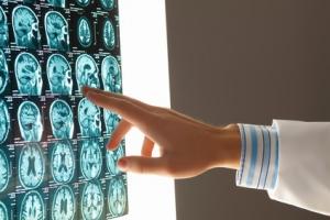 SCLÉROSE en plaques: Les statines efficaces contre l'atrophie du cerveau – The Lancet