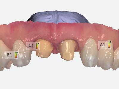 Nouveau : la prise de teinte numérique directement pendant l'empreinte optique
