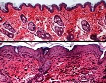 L'ECZÉMA, un curieux rempart contre le cancer de la peau  – eLife