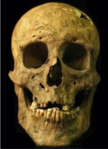Un cas d'acromégalie il y a 3800 ans en Californie